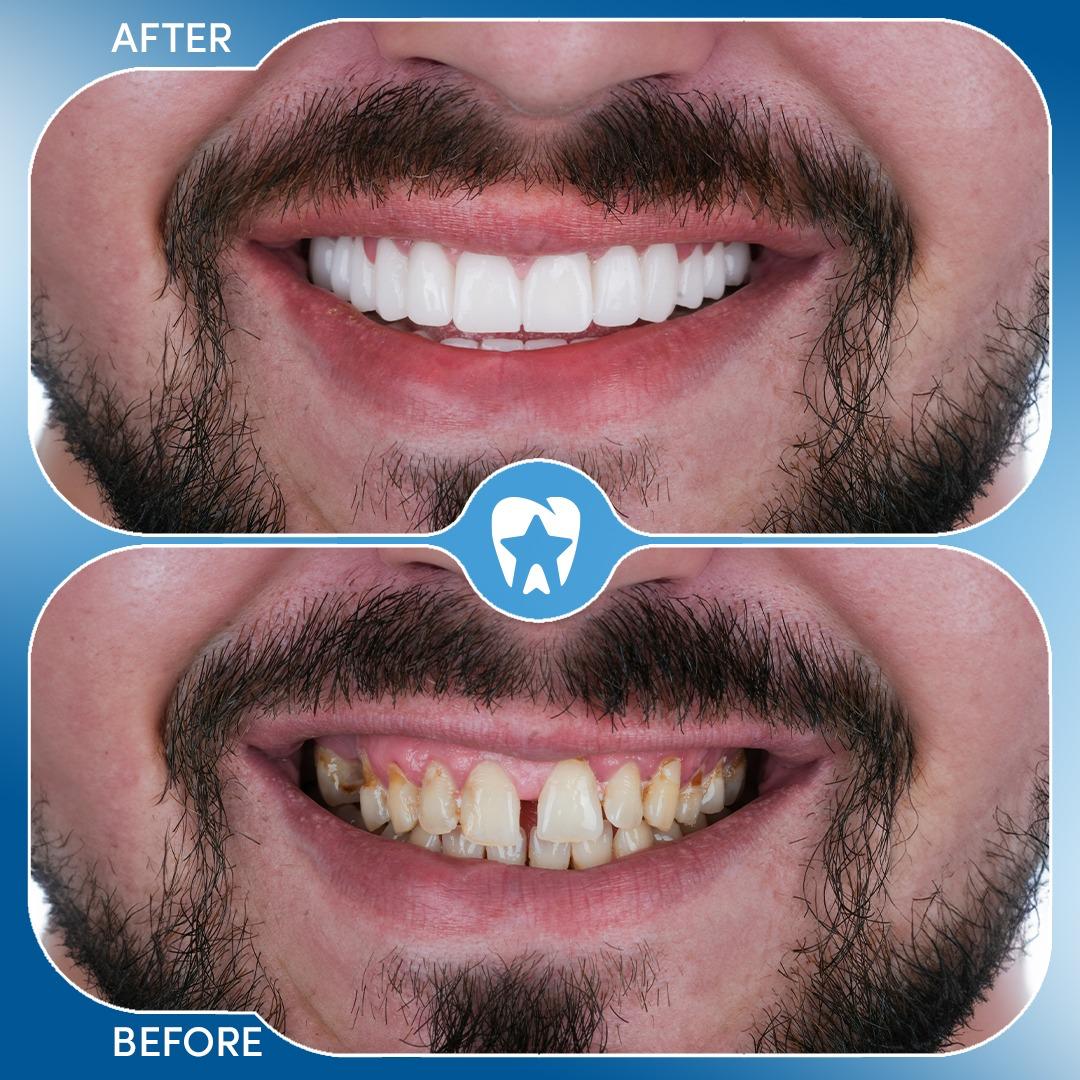 Dental Implant in Turkey